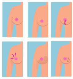 breast cancer signs.JPG